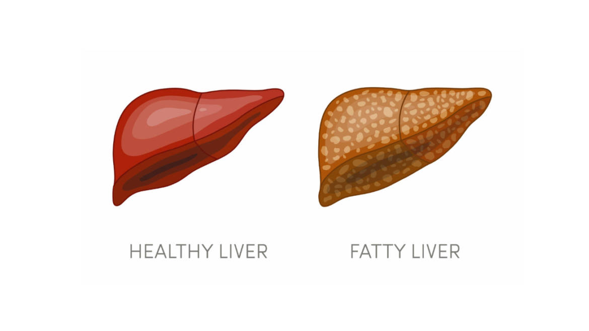 Fatty Liver