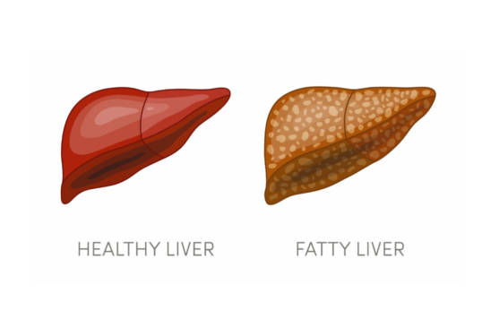 Fatty Liver