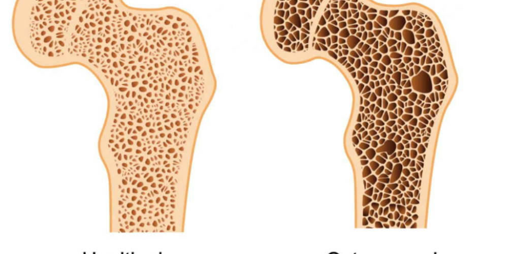 Osteoporosis & Osteoarthritis
