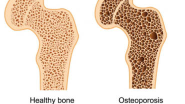 Osteoporosis & Osteoarthritis