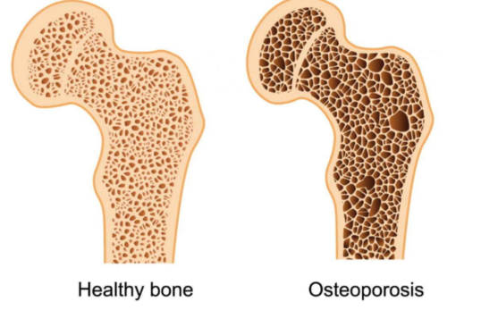 Osteoporosis & Osteoarthritis