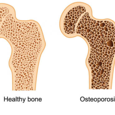 Osteoporosis & Osteoarthritis